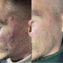 Linija preparata SKIN RESCUE je namenjena tretiranju problematične kože sa aknama. Primer slika 1 posle koriscenja jednog seta Skin Rescue.